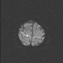 File:Balo concentric sclerosis (Radiopaedia 50458-55940 Axial DWI 49).jpg