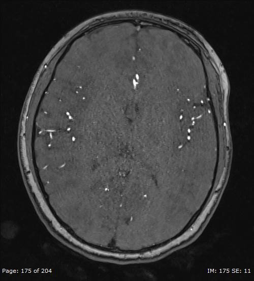 Balo concentric sclerosis (Radiopaedia 61637-69636 Axial MRA 175).jpg