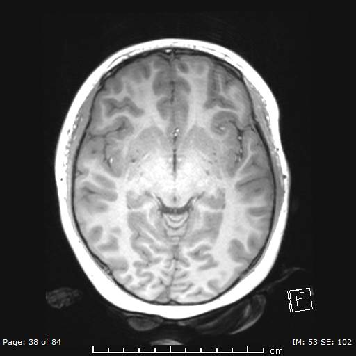Balo concentric sclerosis (Radiopaedia 61637-69636 Axial T1 38).jpg