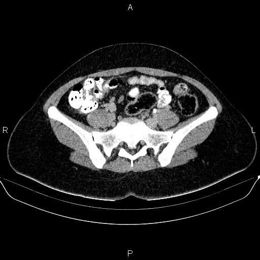 Bartholin gland cyst (Radiopaedia 62635-70930 C 19).jpg