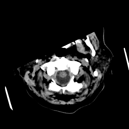 Basal ganglia metastasis (Radiopaedia 78928-91830 Axial non-contrast 9).png