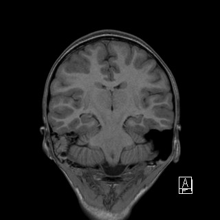 Base of skull rhabdomyosarcoma (Radiopaedia 32196-33142 Coronal T1 28).jpg