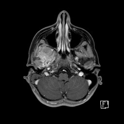 Base of skull rhabdomyosarcoma (Radiopaedia 32196-33142 T1 C+ fat sat 27).jpg