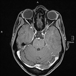 File:Basilar artery perforator aneurysm (Radiopaedia 82455-99523 G 45).jpg