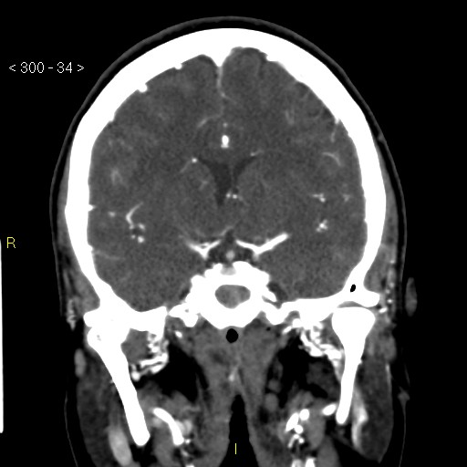 Basilar artery thrombosis (Radiopaedia 16260-15944 B 25).jpg