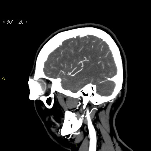 File:Basilar artery thrombosis (Radiopaedia 16260-15944 C 14).jpg