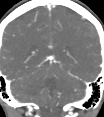 Basilar tip aneurysm with coiling (Radiopaedia 53912-60086 B 107).jpg