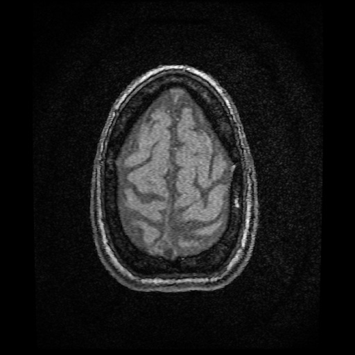 Basilar top and left middle cerebral artery aneurysm (Radiopaedia 61965-70031 Axial MRA 159).jpg