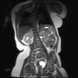File:Beckwith-Wiedeman syndrome with bilateral Wilms tumors (Radiopaedia 60850-69233 B 9).jpg