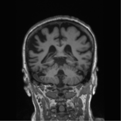 Behavioral variant frontotemporal dementia and late onset schizophrenia (Radiopaedia 52197-58083 Coronal T1 38).png