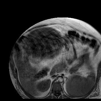 File:Benign seromucinous cystadenoma of the ovary (Radiopaedia 71065-81300 Axial T1 34).jpg