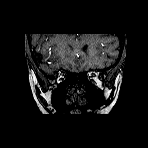 Berry aneurysm of the terminal internal carotid artery (Radiopaedia 88286-104918 Coronal TOF 15).jpg