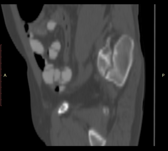 Bertolotti syndrome (Radiopaedia 58974-66235 Sagittal bone window 51).jpg