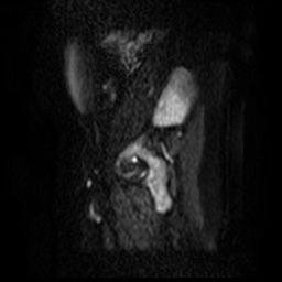 File:Bicornuate uterus (Radiopaedia 51676-57472 Sagittal DWI 24).jpg