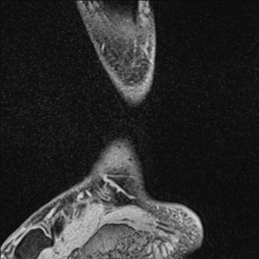 Bilateral Achilles tendon complete tear (Radiopaedia 81344-95051 Sagittal WE - Left 23).jpg