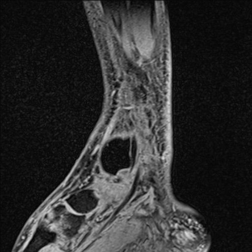 Bilateral Achilles tendon complete tear (Radiopaedia 81344-95051 Sagittal WE - Right 83).jpg