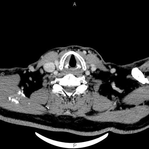 Bilateral Warthin tumors (Radiopaedia 84034-99263 Axial With contrast 49).jpg