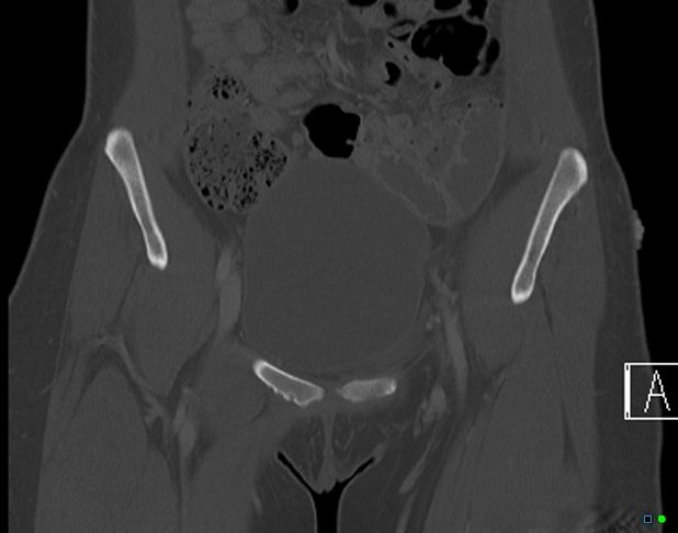 File:Bilateral acetabular fractures (Radiopaedia 79272-92308 Coronal bone window 6).jpg