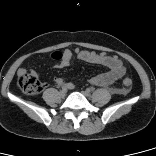 Bilateral adrenal gland hyperenhancement in pancreatitis (Radiopaedia 86642-102753 Axial non-contrast 78).jpg