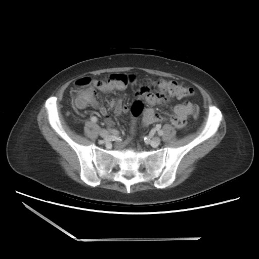 Bilateral adrenal granulocytic sarcomas (chloromas) (Radiopaedia 78375-91007 A 85).jpg