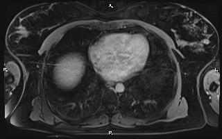 Bilateral adrenal myelolipoma (Radiopaedia 63058-71537 H 6).jpg
