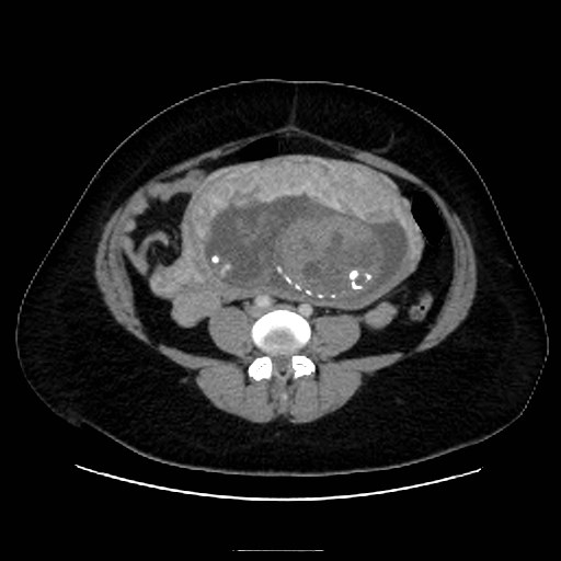 Bilateral adrenal thrombosis (Radiopaedia 58182-65256 A 48).jpg