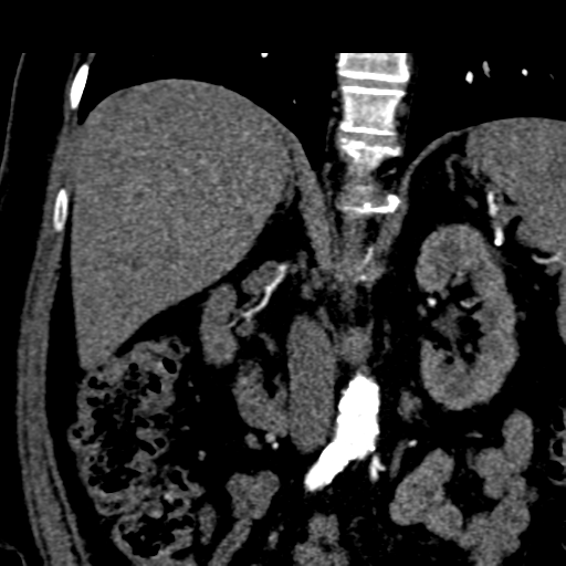 File:Bilateral delayed nephrogram from renal artery stenosis (Radiopaedia 47681-52362 C 7).png