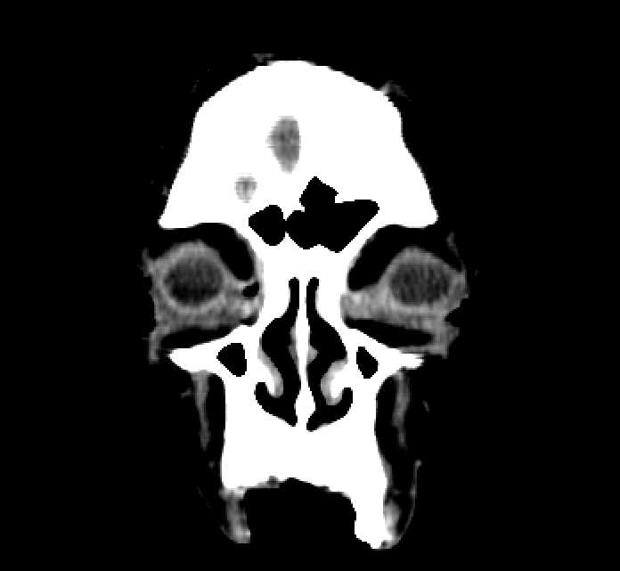 Bilateral ectopia lentis (Radiopaedia 89889-107013 Coronal non-contrast 14).jpg