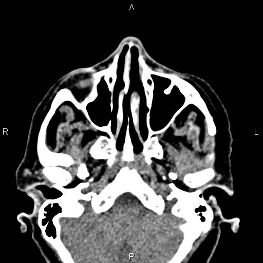 Bilateral enlargement of lacrimal glands - sarcoidosis (Radiopaedia 62627-70921 Axial non-contrast 19).jpg
