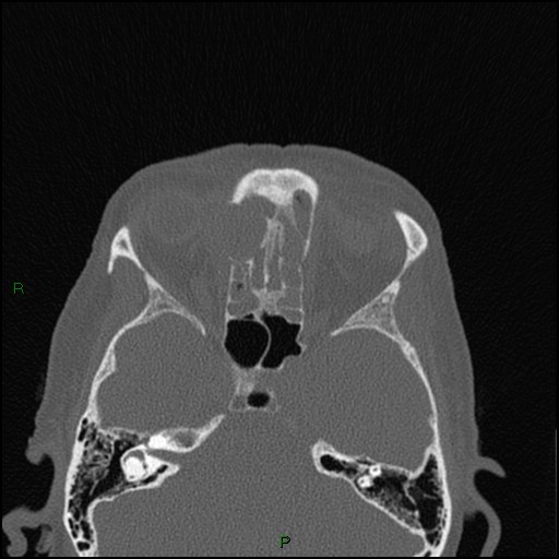 File:Bilateral frontal mucoceles (Radiopaedia 82352-96454 Axial bone window 132).jpg