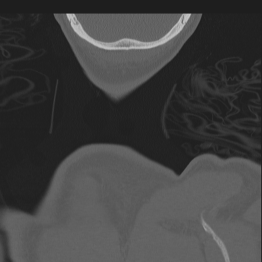 Bilateral locked facets (Radiopaedia 33850-35016 Coronal bone window 97).png