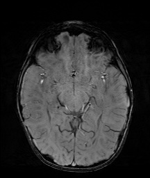 Bilateral mesial temporal polymicrogyria (Radiopaedia 76456-88181 Axial SWI 29).jpg