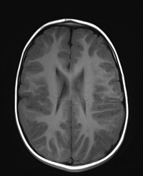 File:Bilateral mesial temporal polymicrogyria (Radiopaedia 76456-88181 Axial T1 16).jpg