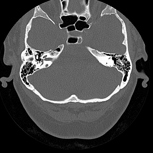 File:Bilateral ossifications of the external auditory canal (Radiopaedia 15233-15076 Axial bone window 4).jpg
