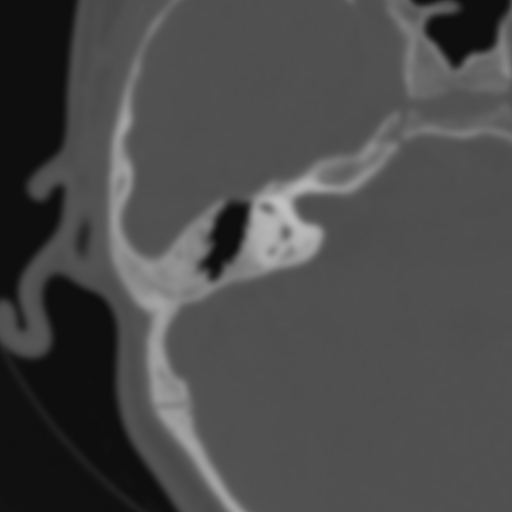 File:Bilateral otosclerosis (Radiopaedia 57237-64157 B 70).jpg