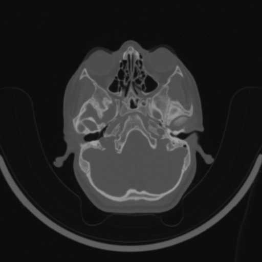 Bilateral otosclerosis (Radiopaedia 57237-64157 C 32).jpg