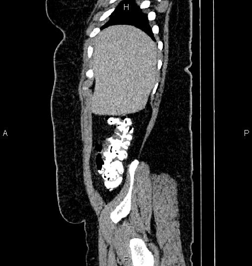 Bilateral ovarian dermoid cysts (Radiopaedia 85785-101603 D 9).jpg