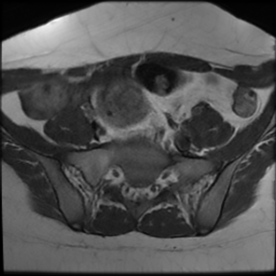 File:Bilateral ovarian fibrothecomas - adolescent (Radiopaedia 86604-102707 Axial T1 7).jpg
