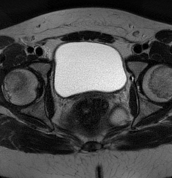 File:Bilateral ovarian fibrothecomas - adolescent (Radiopaedia 86604-102707 Axial T2 35).jpg