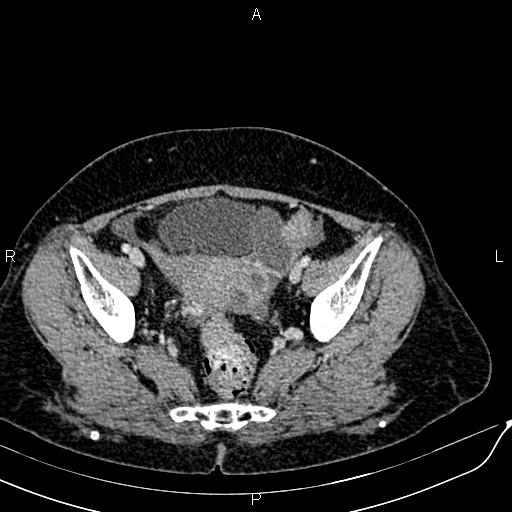 Bilateral ovarian serous cystadenocarcinoma (Radiopaedia 86062-101989 B 87).jpg