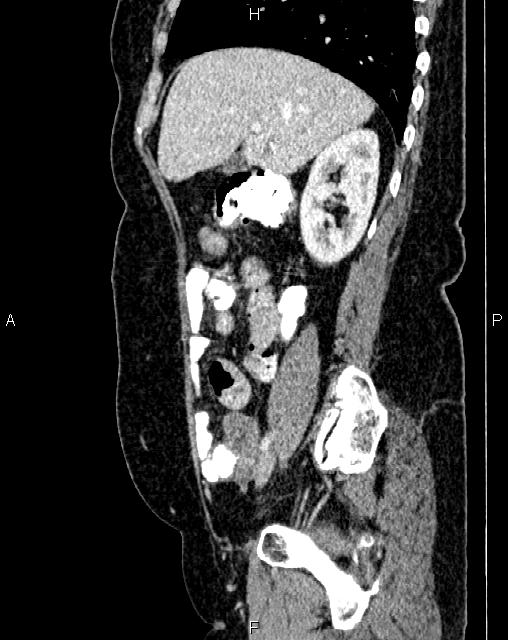Bilateral ovarian serous cystadenocarcinoma (Radiopaedia 86062-101989 E 23).jpg