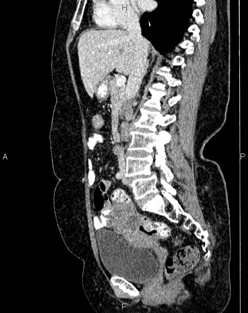Bilateral ovarian serous cystadenocarcinoma (Radiopaedia 86062-101989 E 37).jpg