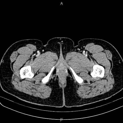 Bilateral ovarian teratoma (Radiopaedia 83131-97503 Axial With contrast 92).jpg