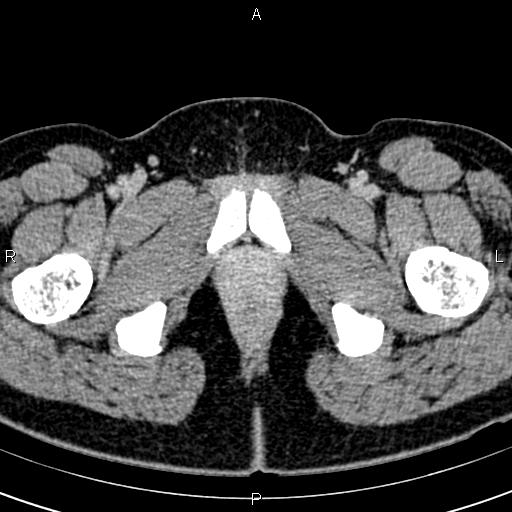 Bilateral ovarian teratoma (Radiopaedia 83131-97503 B 85).jpg