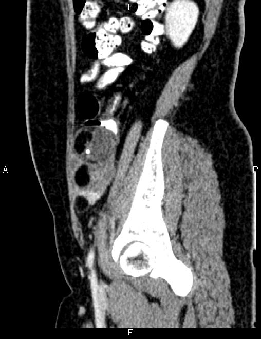 Bilateral ovarian teratoma (Radiopaedia 83131-97503 D 39).jpg
