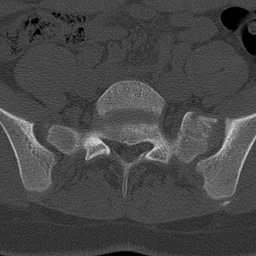 Bilateral pars defect (Radiopaedia 26691-26846 Axial bone window 71).jpg