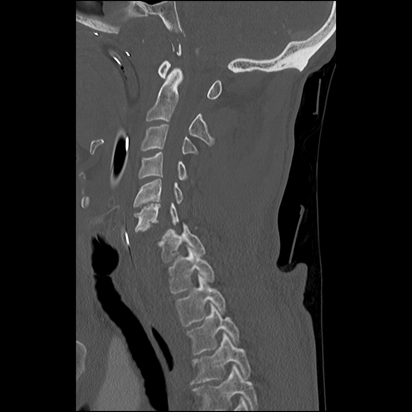 Bilateral perched facets with cord injury (Radiopaedia 45587-49713 Sagittal bone window 22).jpg