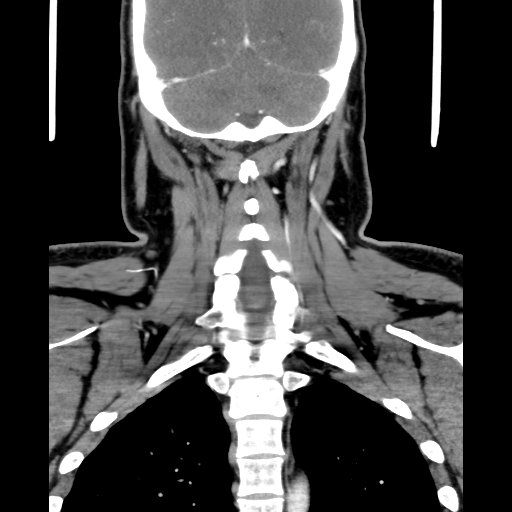 Bilateral peritonsillar abscess (Radiopaedia 85065-100610 Coronal 57).jpg