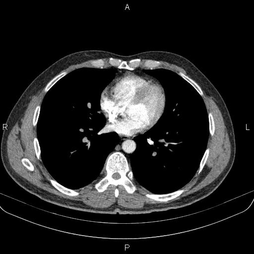Bilateral pulmonary AVM (Radiopaedia 83134-97505 A 44).jpg