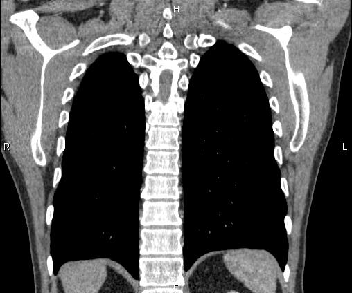 File:Bilateral pulmonary AVM (Radiopaedia 83134-97505 C 59).jpg